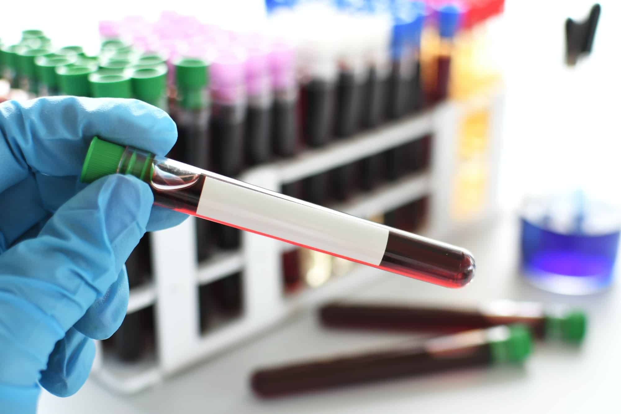 Medical worker lab technician holding vial of blood for testing, blank label mock up text overlay