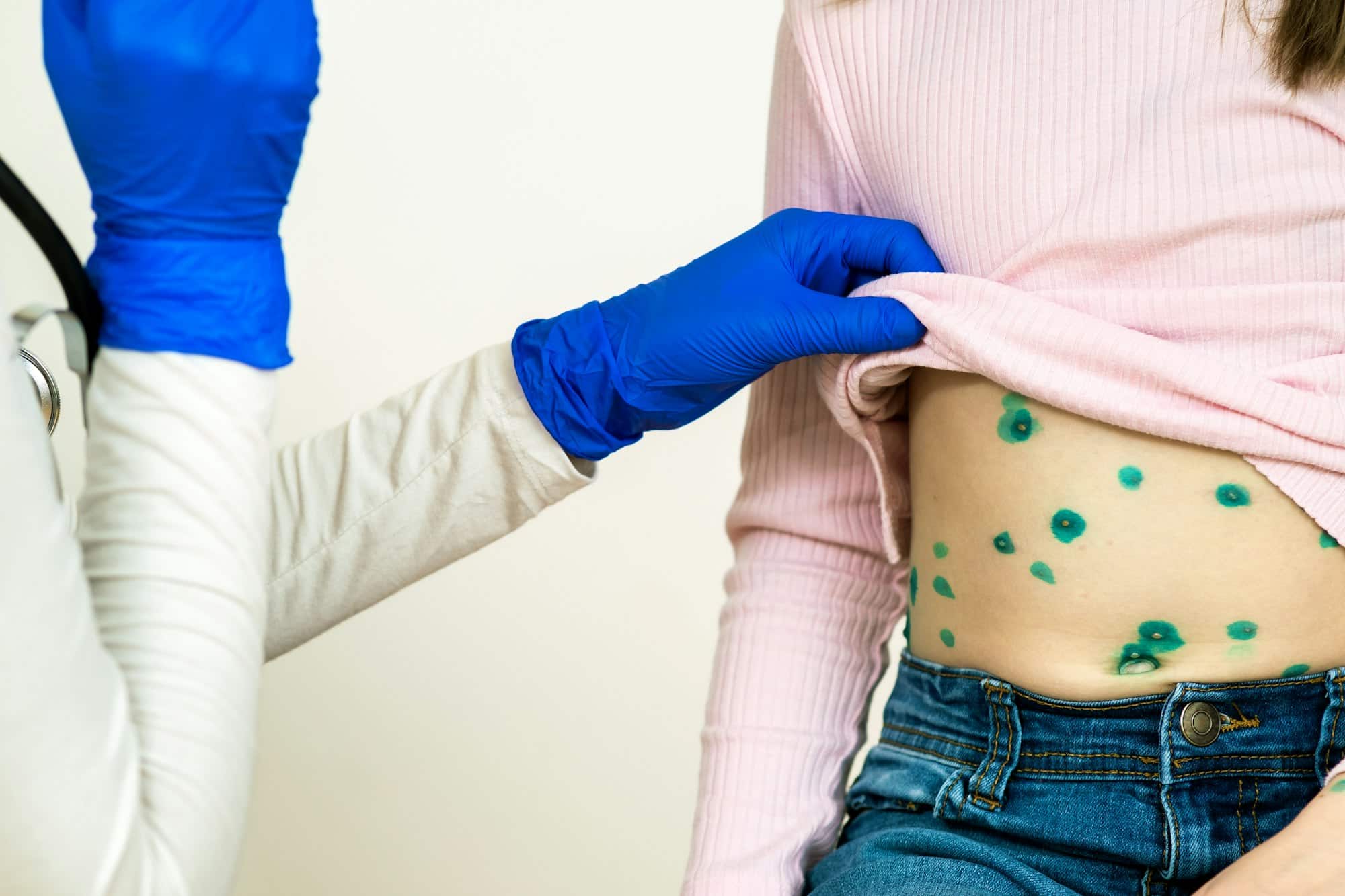 Doctor examining a child covered with green rashes on stomach ill with chickenpox