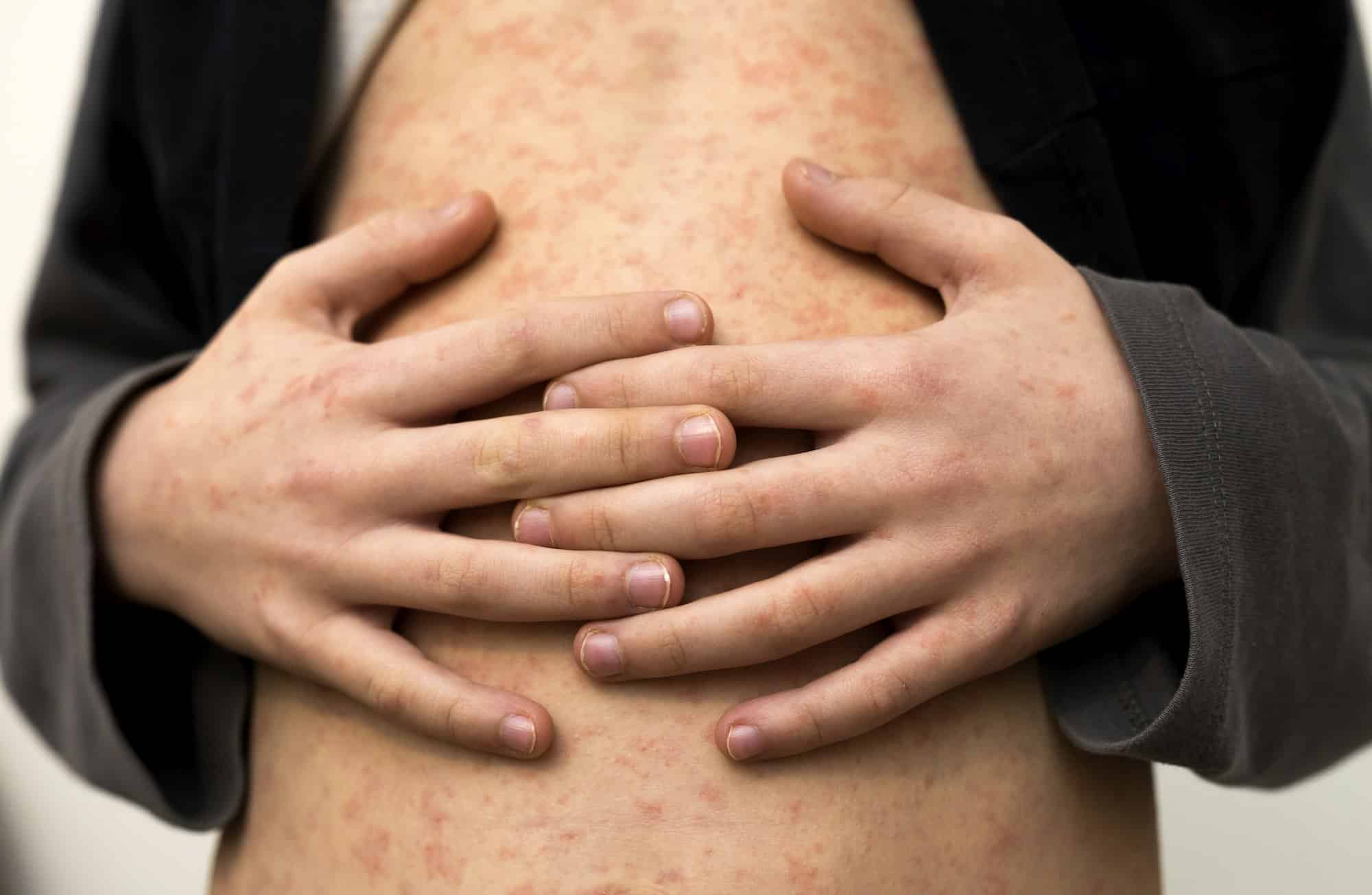 Sick child body, stomach with red rush spots from measles or chicken pox.