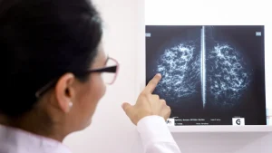 Expansion of breast cancer screening should cover 1.5 million women