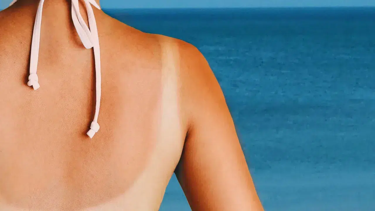 Go to the beach Here are the areas most vulnerable to sunburn (and how to prevent it)