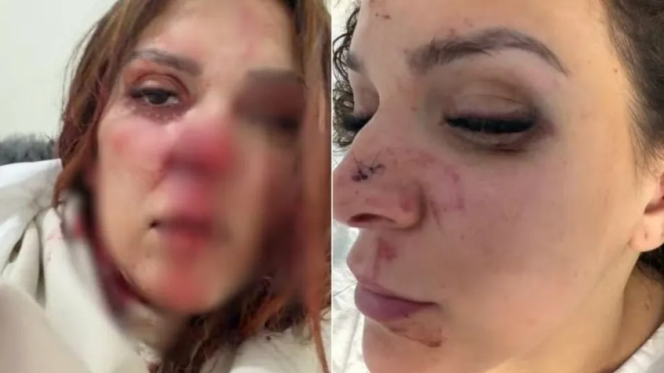 Woman beaten by her husband in Porto. Suspect fled to Brazil