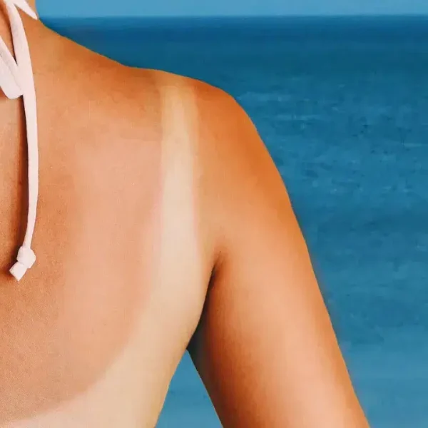 Go to the beach Here are the areas most vulnerable to sunburn (and how to prevent it)